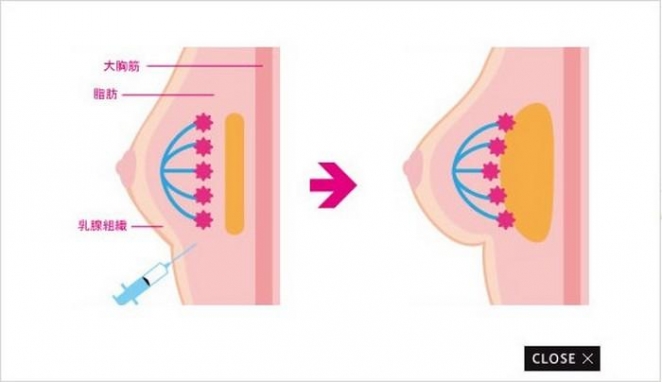 "Пластика Золушки": японцы практикуют увеличение груди на сутки