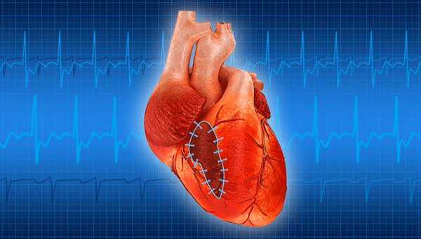 "Это самый эффективный метод". Ученый рассказал, как избежать инфаркта