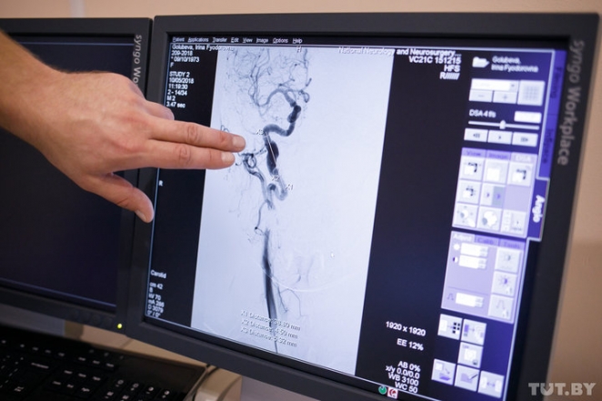 "Мучилась от головных болей 23 года". Белорусские врачи спасли женщину с редким заболеванием