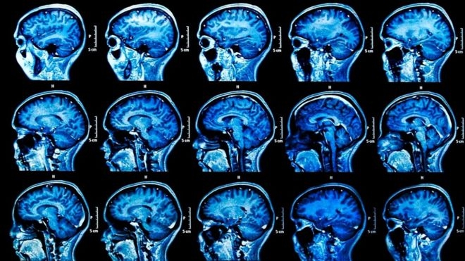Есть весомые свидетельства, что герпес ведет к Альцгеймеру. Что теперь? Есть весомые свидетельства, что герпес ведет к Альцгеймеру. Что теперь?