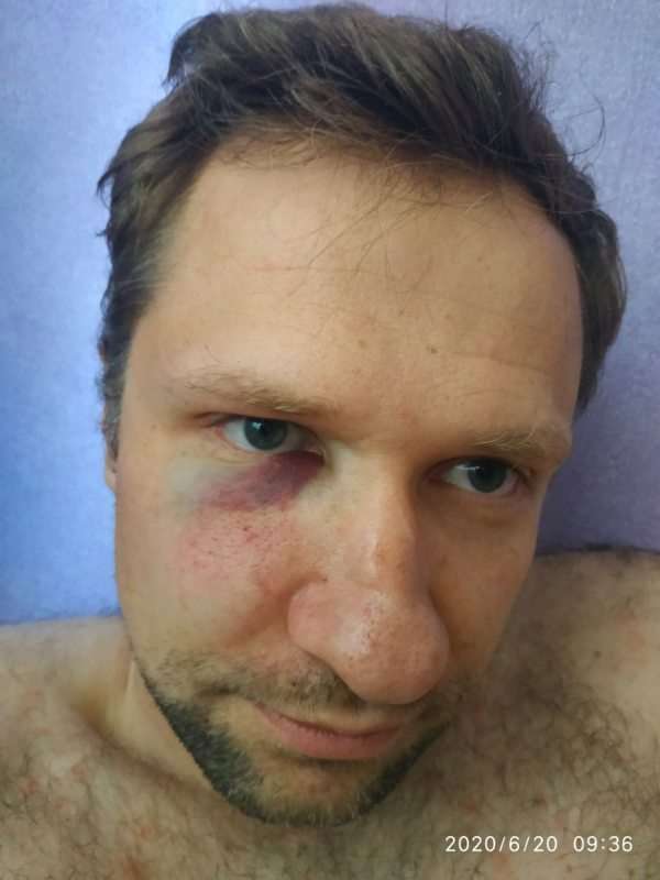 «Били ногами и по голове».  Девушка пострадавшего рассказала, как ее парня избил ОМОН