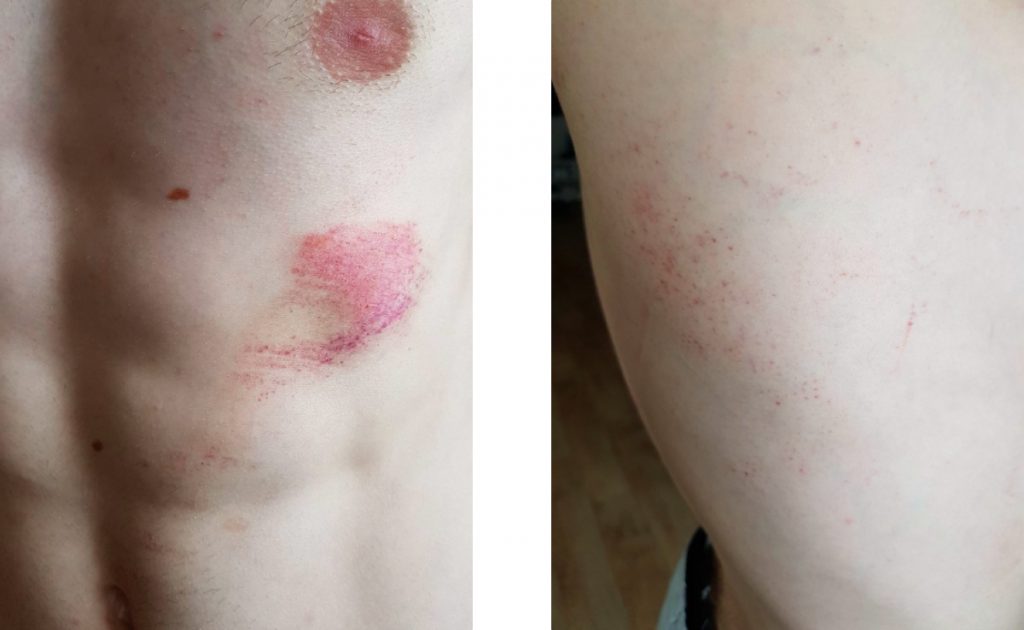 “They Broke My Nose.” Minskers Who Needed Medical Help After Detentions Speak