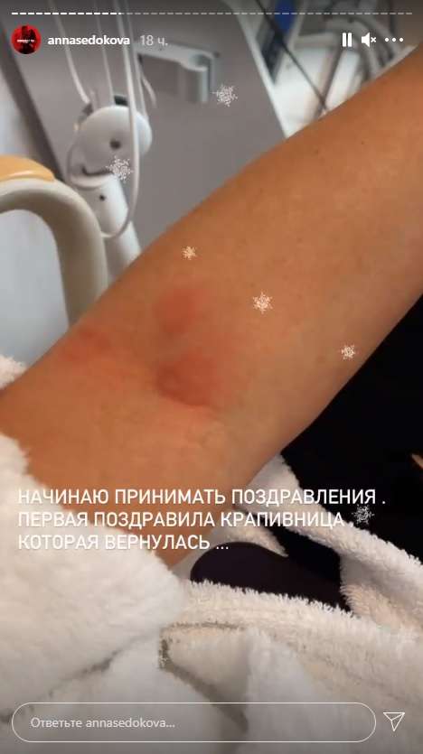 Анна Седокова встретила день рождения с кожным заболеванием