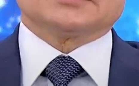 Пластический хирург объяснил, что за «шрам» на шее путина