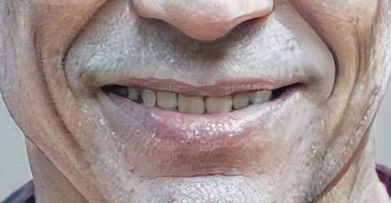 Пенсионеру пересадили кусок нижней губы на половой орган: остался доволен