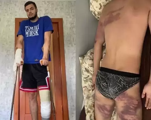 «Буду стрелять на поражение!» История парня, которого ужасно избили за то, что посигналил в знак солидарности